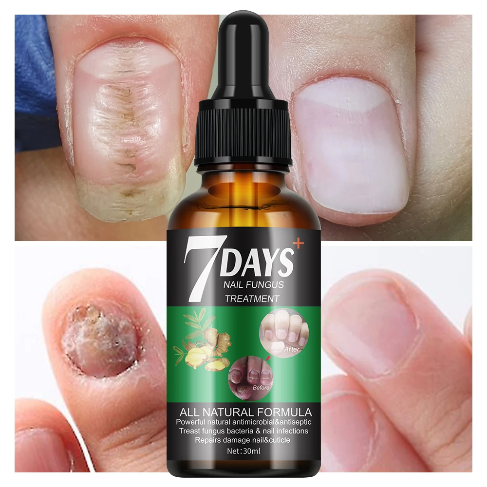 Wholesale Mooyam 7 Day Natural Repairing Preventing Anti-fungal Nail Treatment Nail Fungus Serum - Buy  Product on Alibaba.com